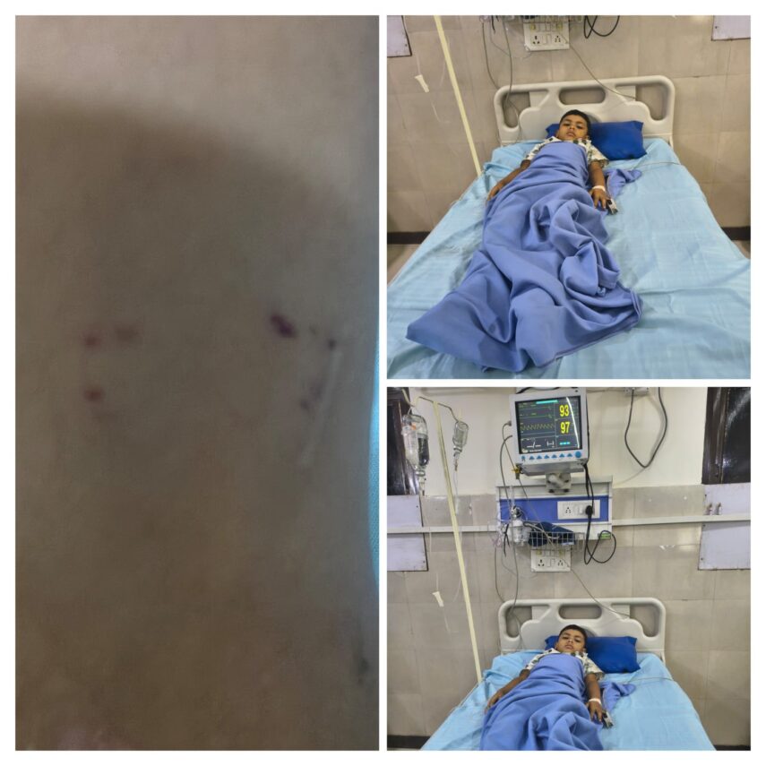 सांप के काटने से गंभीर बच्चे की HBM हॉस्पिटल में बची जान, डॉक्टरों की तत्परता से मिला नया जीवन